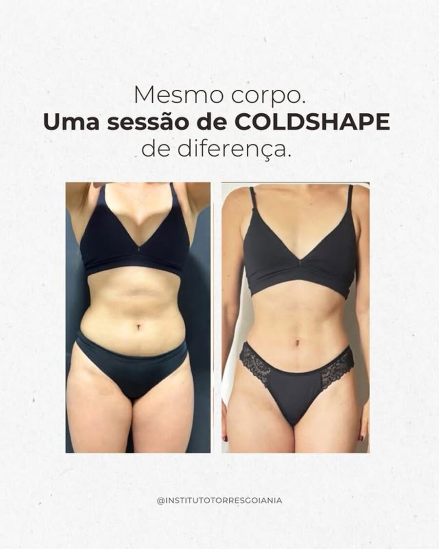 Antes e depois de criolipólise ColdShape no Instituto Torres em Goiânia